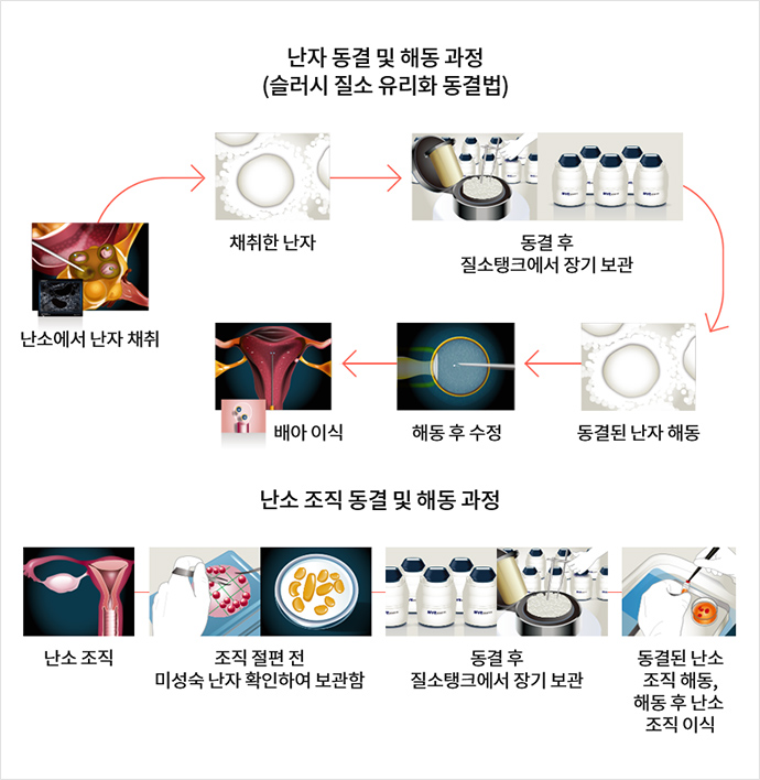 난소 조직 동결