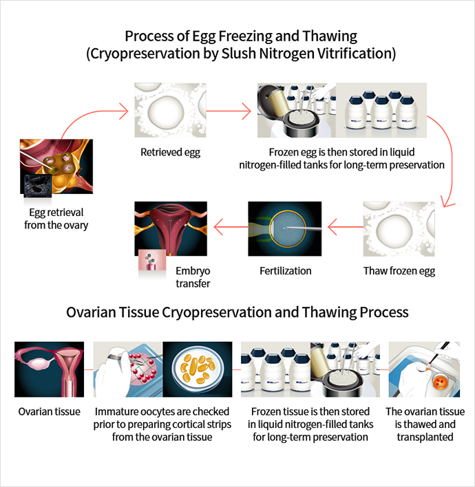 Ovarian Tissue Cryopreservation
